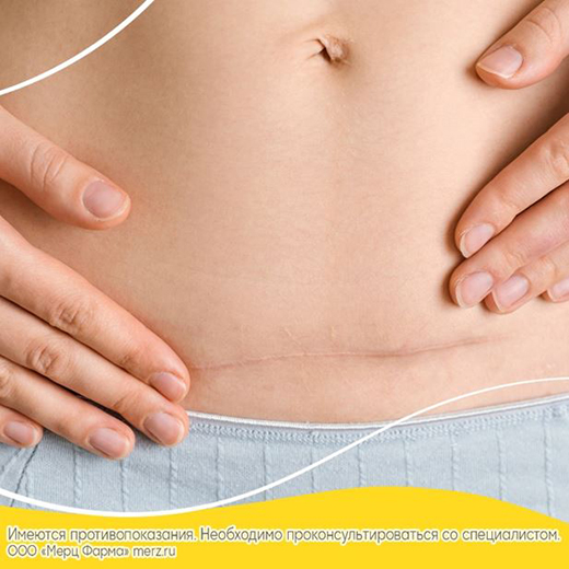 Рубцевание